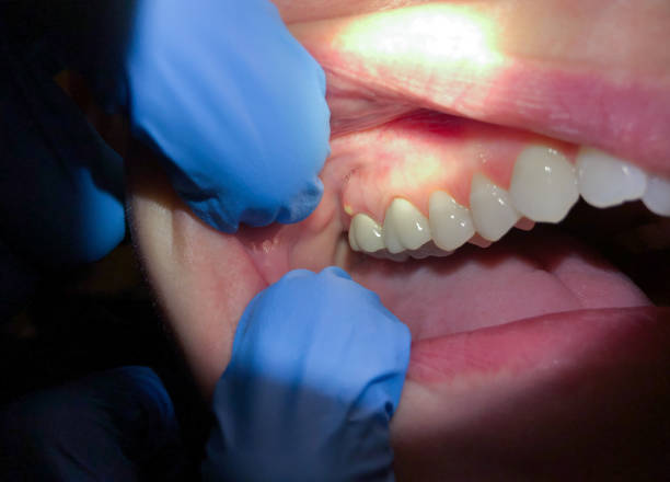 Best Emergency Dental Extractions in Atkinson, IL